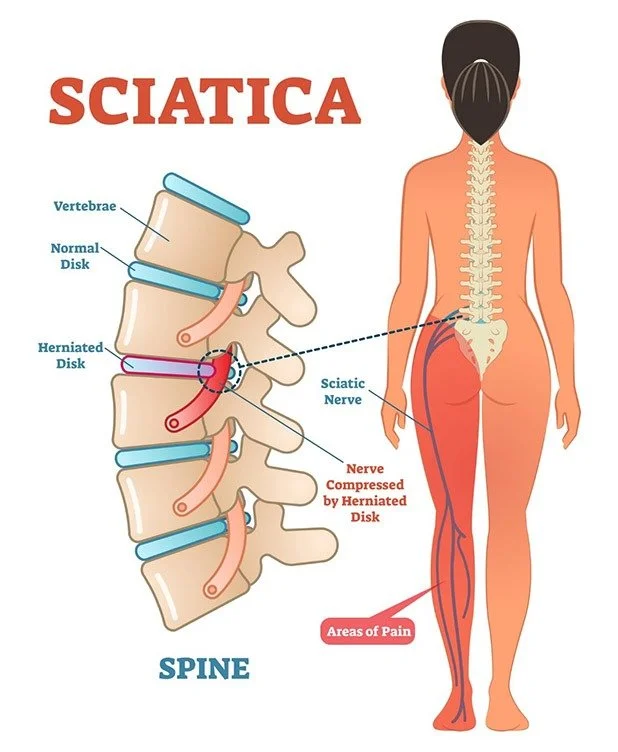 HELP WITH SCIATICA AND PINCHED NERVES